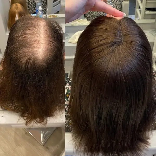 Before and after of a women’s topper Hair System: thin crown before, full hair after
