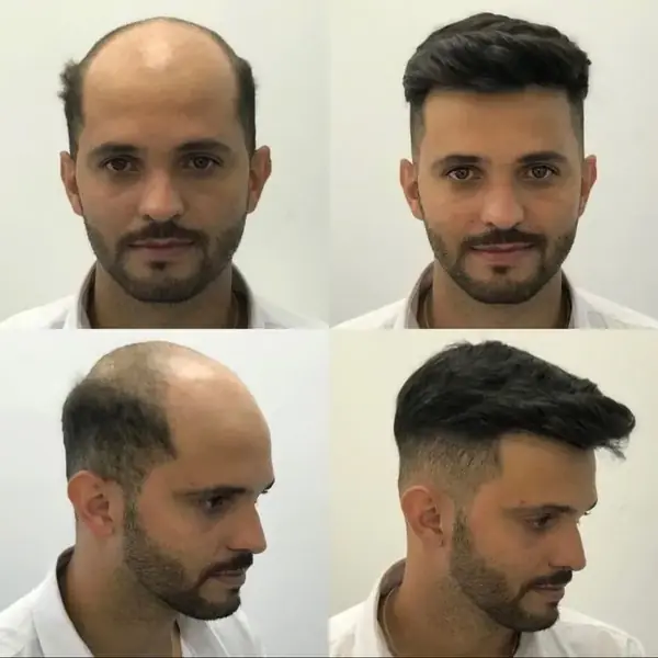 Before and after of a men’s Hair System, front and side view