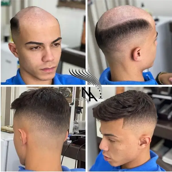 Before and after of a men’s Hair System with a faded finish, side and back views
